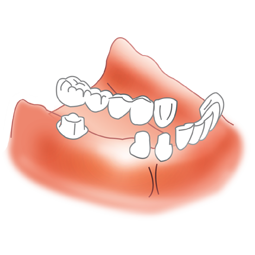 prothèse dentaire conjointe